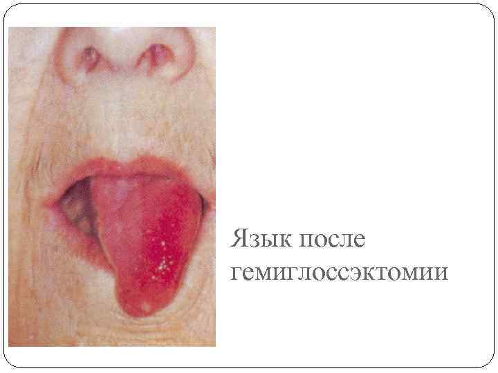 Язык после гемиглоссэктомии 