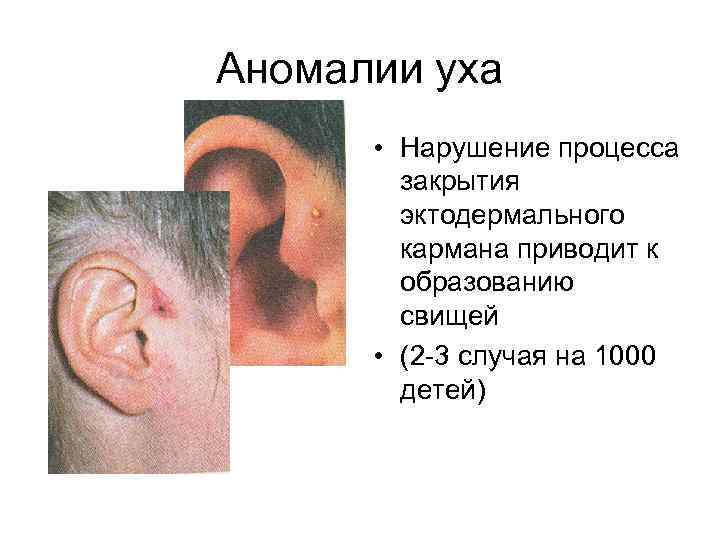 Аномалии уха • Нарушение процесса закрытия эктодермального кармана приводит к образованию свищей • (2