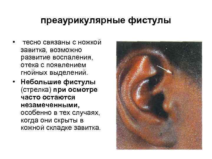 преаурикулярные фистулы • тесно связаны с ножкой завитка, возможно развитие воспаления, отека с появлением