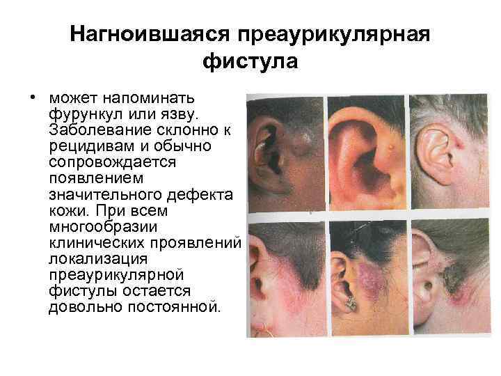 Нагноившаяся преаурикулярная фистула • может напоминать фурункул или язву. Заболевание склонно к рецидивам и