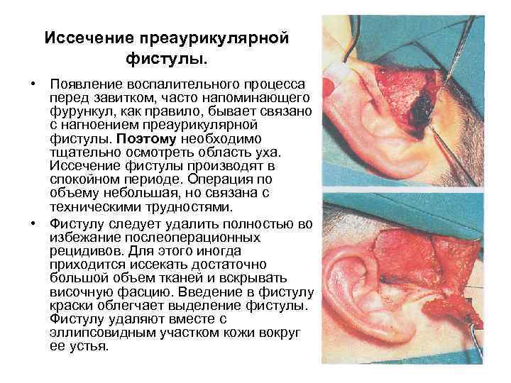 Иссечение преаурикулярной фистулы. • Появление воспалительного процесса перед завитком, часто напоминающего фурункул, как правило,