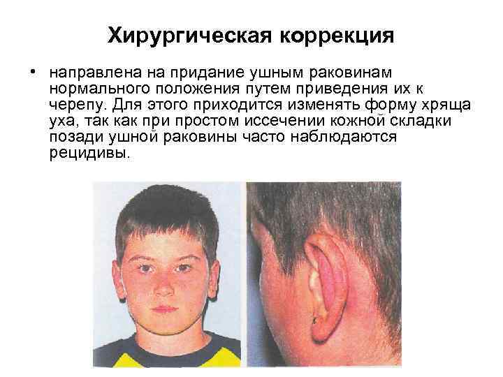 Хирургическая коррекция • направлена на придание ушным раковинам нормального положения путем приведения их к