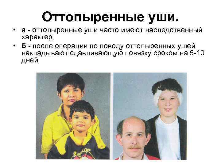 Оттопыренные уши. • а оттопыренные уши часто имеют наследственный характер; • б после операции