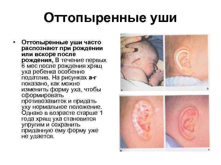 Оттопыренные уши • Оттопыренные уши часто распознают при рождении или вскоре после рождения, В