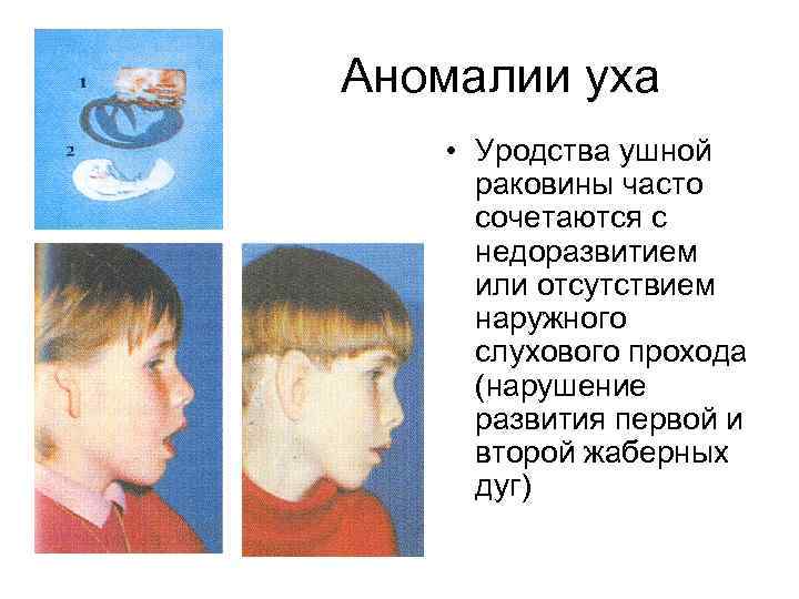 Аномалии уха • Уродства ушной раковины часто сочетаются с недоразвитием или отсутствием наружного слухового