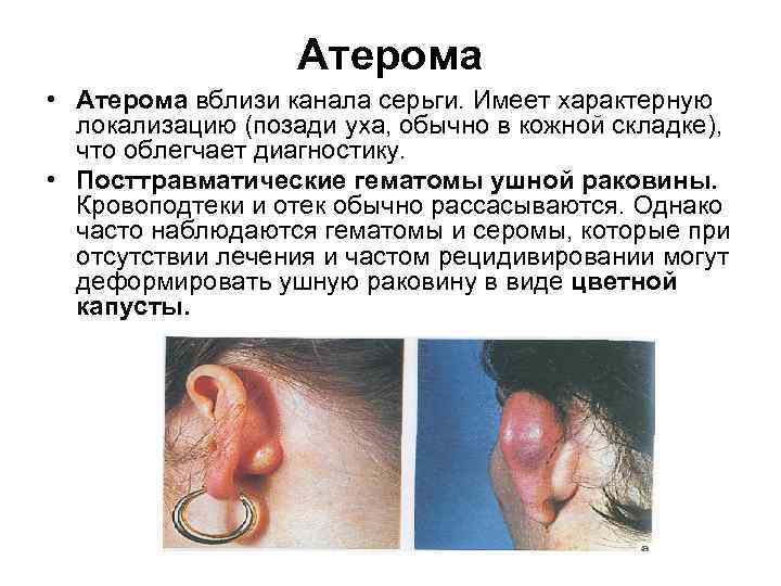 Атерома • Атерома вблизи канала серьги. Имеет характерную локализацию (позади уха, обычно в кожной