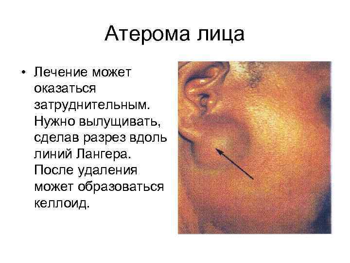 Атерома лица • Лечение может оказаться затруднительным. Нужно вылущивать, сделав разрез вдоль линий Лангера.