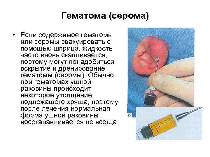 Гематома (серома) • Если содержимое гематомы или серомы эвакуировать с помощью шприца, жидкость часто