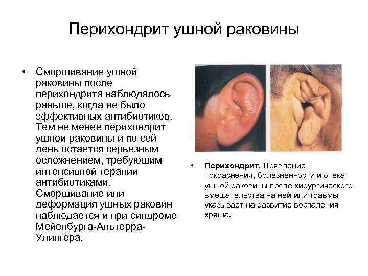 Перихондрит ушной раковины • Сморщивание ушной раковины после перихондрита наблюдалось раньше, когда не было