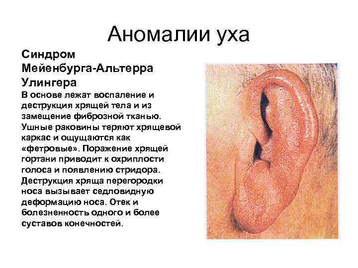 Аномалии уха Синдром Мейенбурга-Альтерра Улингера В основе лежат воспаление и деструкция хрящей тела и