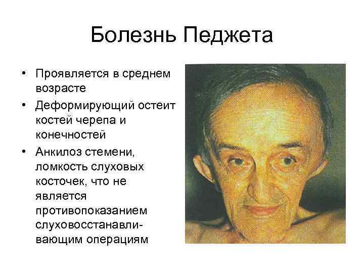 Болезнь Педжета • Проявляется в среднем возрасте • Деформирующий остеит костей черепа и конечностей