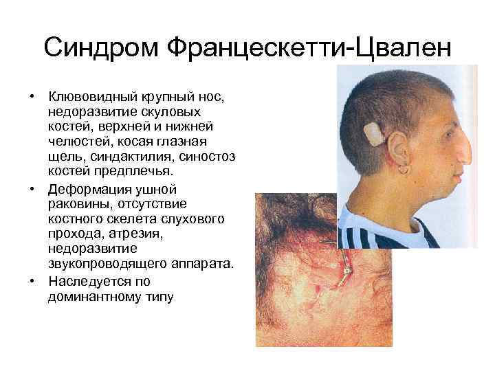 Синдром Францескетти Цвален • Клювовидный крупный нос, недоразвитие скуловых костей, верхней и нижней челюстей,