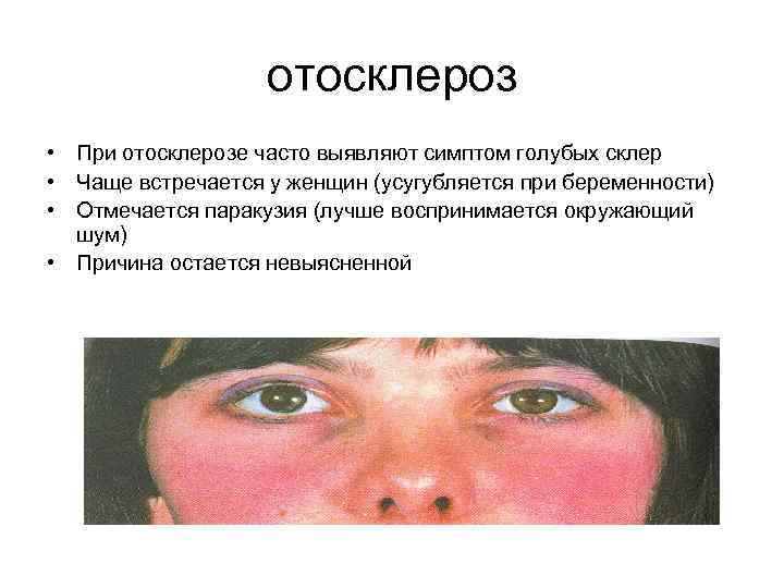 отосклероз • При отосклерозе часто выявляют симптом голубых склер • Чаще встречается у женщин