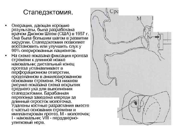 Стапедэктомия. • • Операция, дающая хорошие результаты, была разработана врачом Джоном Шеем (США) в