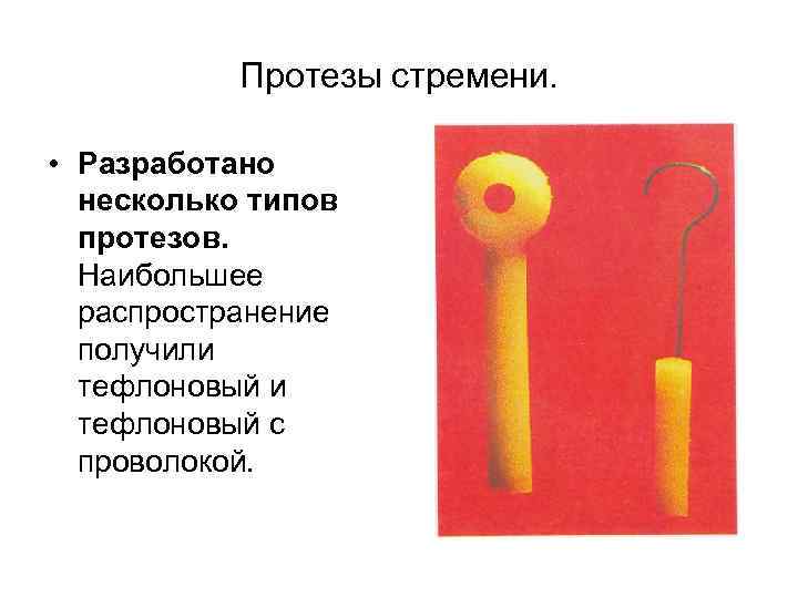 Протезы стремени. • Разработано несколько типов протезов. Наибольшее распространение получили тефлоновый с проволокой. 