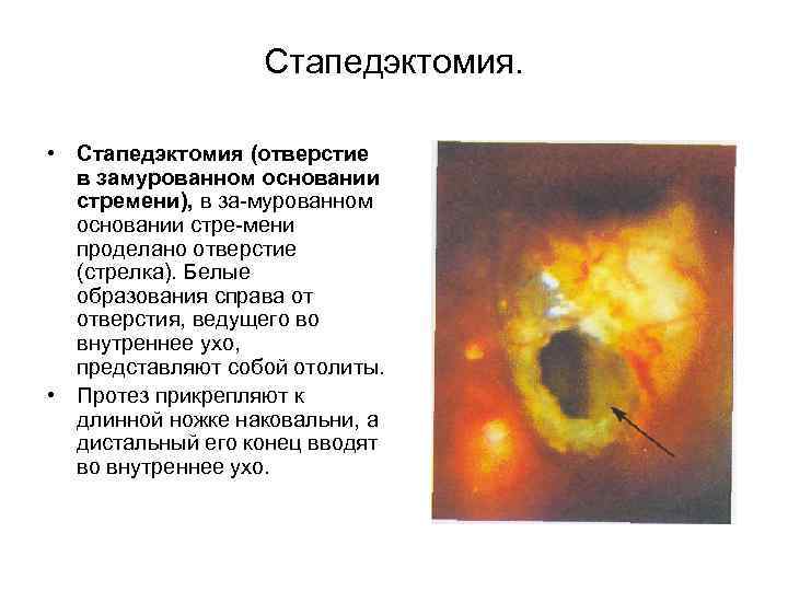 Стапедэктомия. • Стапедэктомия (отверстие в замурованном основании стремени), в за мурованном основании стре мени