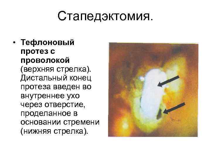 Стапедэктомия. • Тефлоновый протез с проволокой (верхняя стрелка). Дистальный конец протеза введен во внутреннее