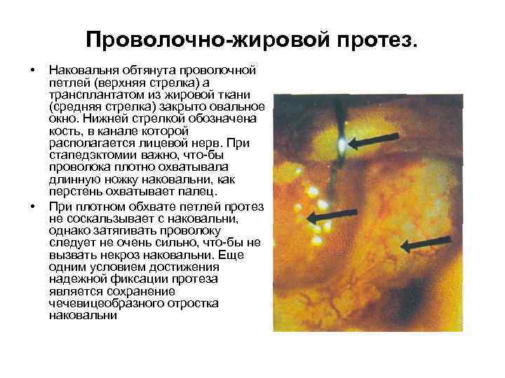 Проволочно-жировой протез. • • Наковальня обтянута проволочной петлей (верхняя стрелка) а трансплантатом из жировой