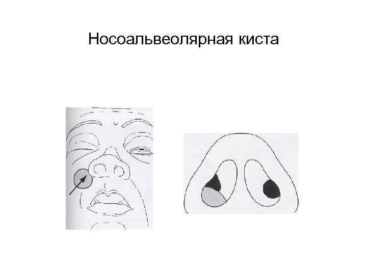 Носоальвеолярная киста 