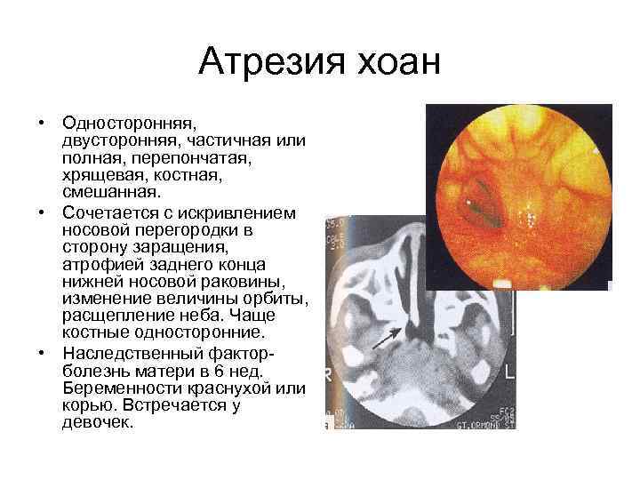 Атрезия хоан • Односторонняя, двусторонняя, частичная или полная, перепончатая, хрящевая, костная, смешанная. • Сочетается
