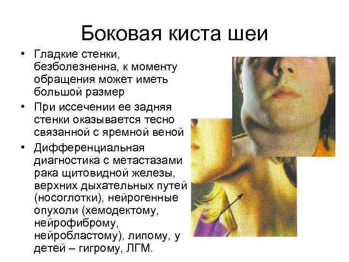 Боковая киста шеи • Гладкие стенки, безболезненна, к моменту обращения может иметь большой размер