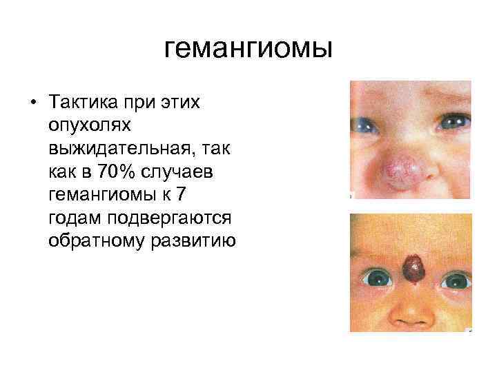 гемангиомы • Тактика при этих опухолях выжидательная, так как в 70% случаев гемангиомы к