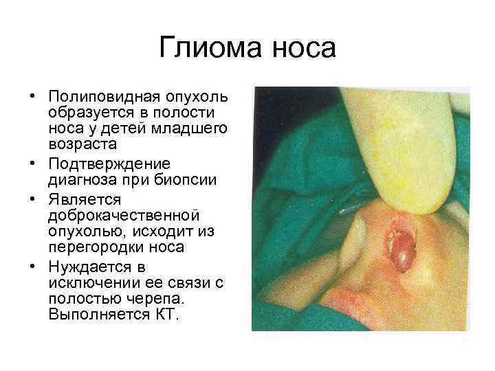 Глиома носа • Полиповидная опухоль образуется в полости носа у детей младшего возраста •