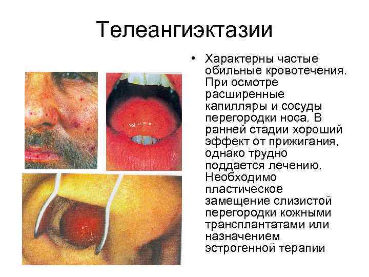 Телеангиэктазии • Характерны частые обильные кровотечения. При осмотре расширенные капилляры и сосуды перегородки носа.