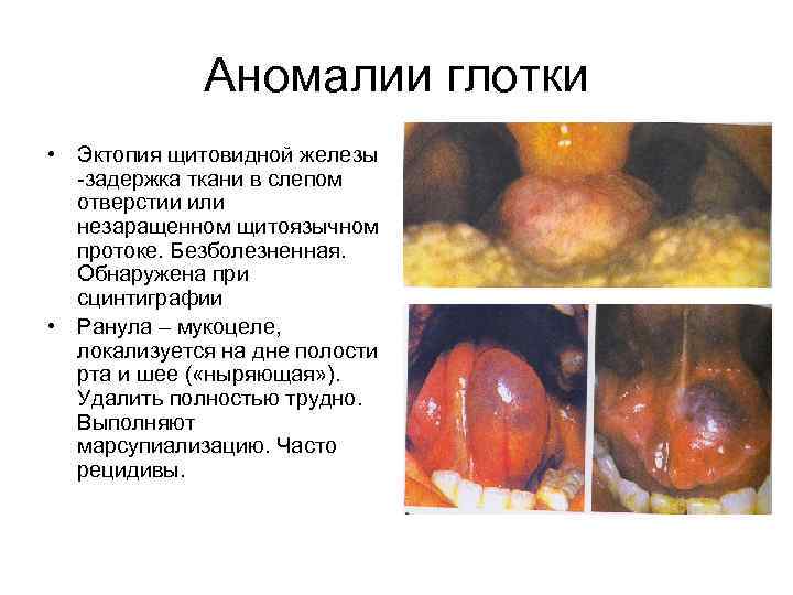 Аномалии глотки • Эктопия щитовидной железы задержка ткани в слепом отверстии или незаращенном щитоязычном