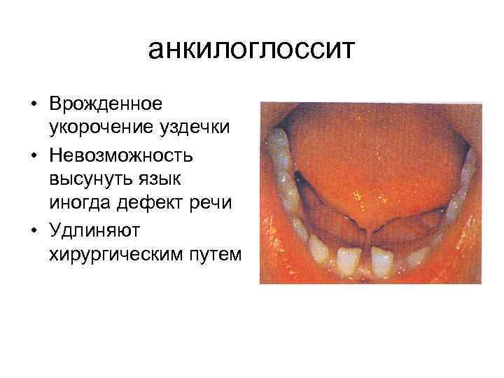 анкилоглоссит • Врожденное укорочение уздечки • Невозможность высунуть язык иногда дефект речи • Удлиняют
