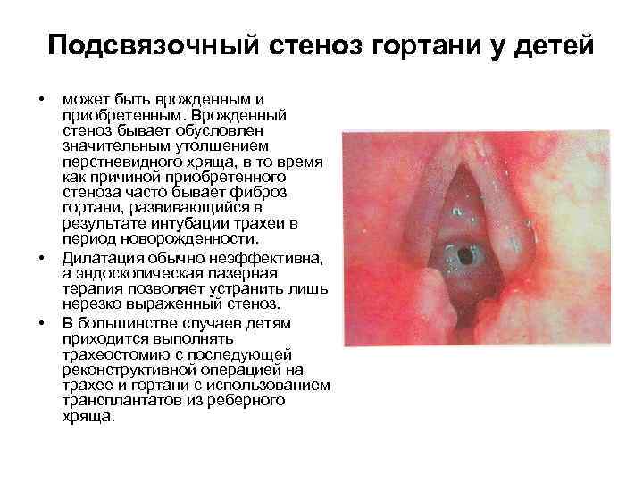 Подсвязочный стеноз гортани у детей • • • может быть врожденным и приобретенным. Врожденный