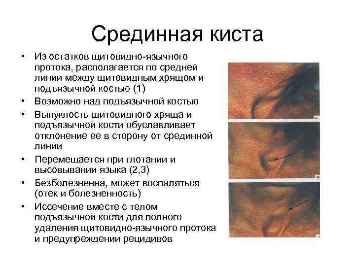 Срединная киста • Из остатков щитовидно язычного протока, располагается по средней линии между щитовидным