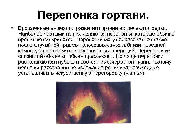 Перепонка гортани. • Врожденные аномалии развития гортани встречаются редко. Наиболее частыми из них являются