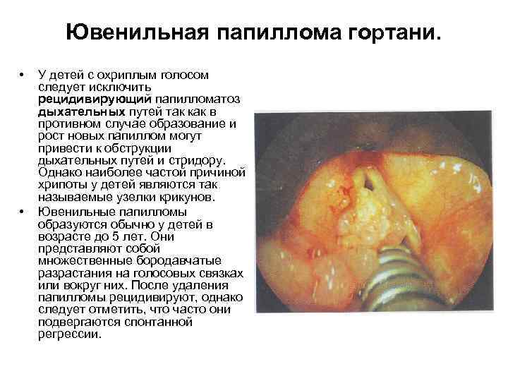 Ювенильная папиллома гортани. • • У детей с охриплым голосом следует исключить рецидивирующий папилломатоз
