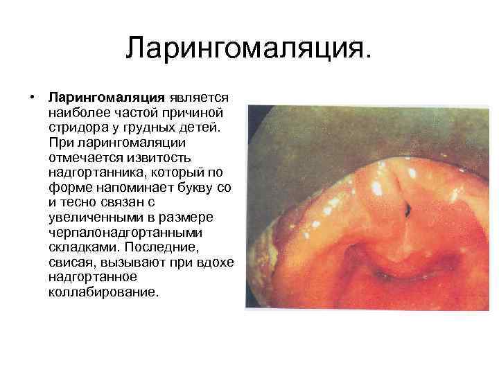 Ларингомаляция. • Ларингомаляция является наиболее частой причиной стридора у грудных детей. При ларингомаляции отмечается