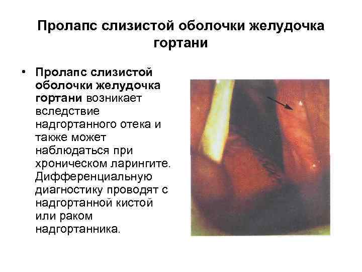 Пролапс слизистой оболочки желудочка гортани • Пролапс слизистой оболочки желудочка гортани возникает вследствие надгортанного