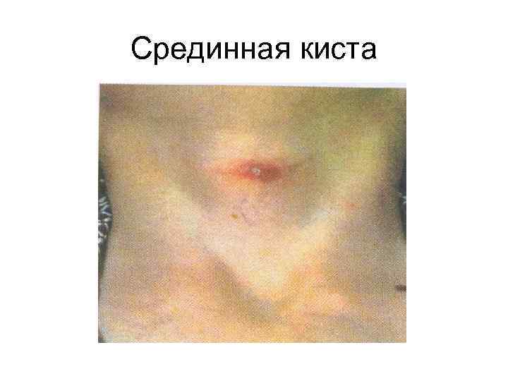 Срединная киста 