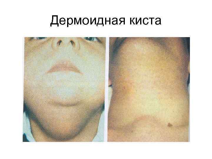 Дермоидная киста 