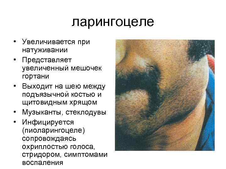 ларингоцеле • Увеличивается при натуживании • Представляет увеличенный мешочек гортани • Выходит на шею