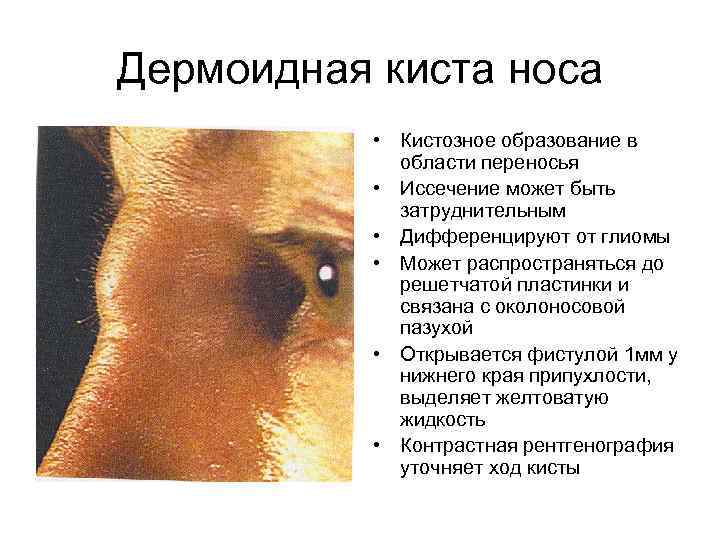 Дермоидная киста носа • Кистозное образование в области переносья • Иссечение может быть затруднительным