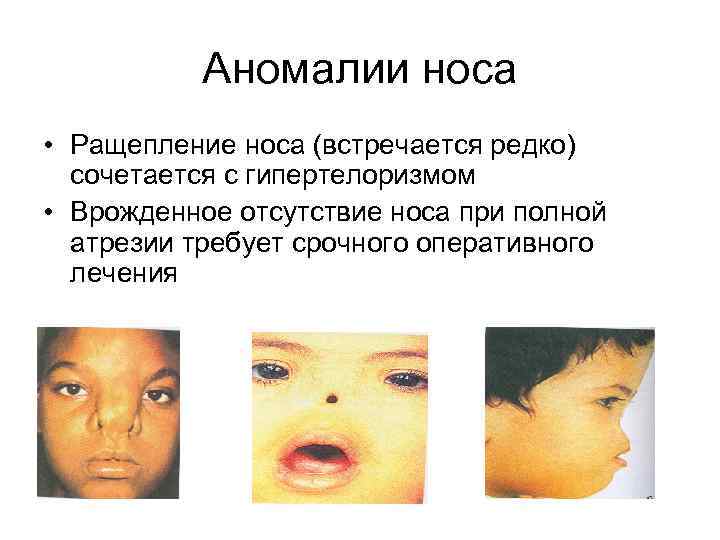 Аномалии носа • Ращепление носа (встречается редко) сочетается с гипертелоризмом • Врожденное отсутствие носа