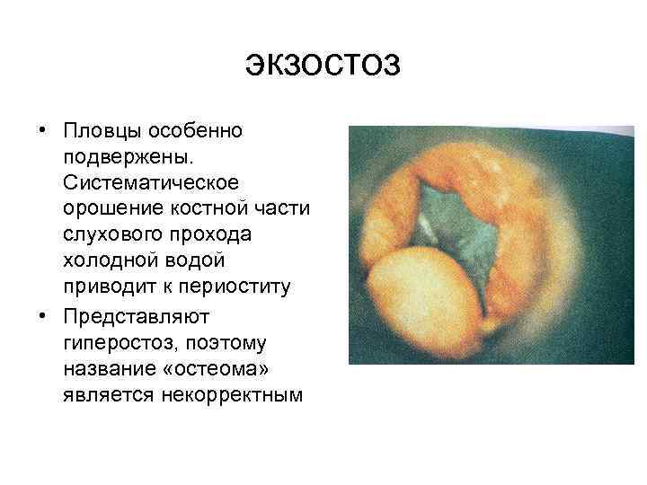 экзостоз • Пловцы особенно подвержены. Систематическое орошение костной части слухового прохода холодной водой приводит
