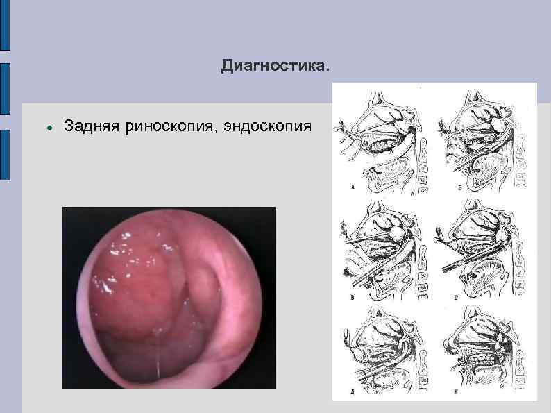 Диагностика. Задняя риноскопия, эндоскопия 