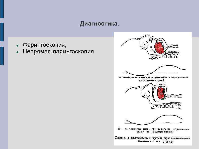 Диагностика. Фарингоскопия, Непрямая ларингоскопия 