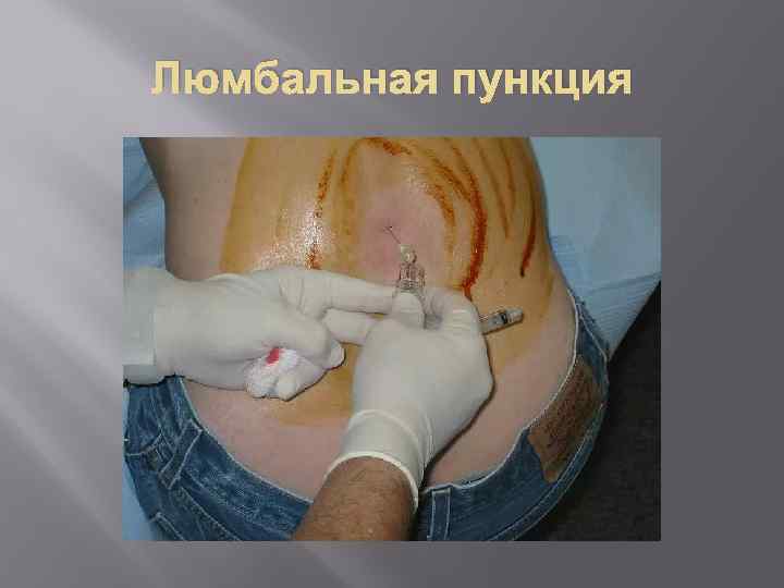 Люмбальная пункция 