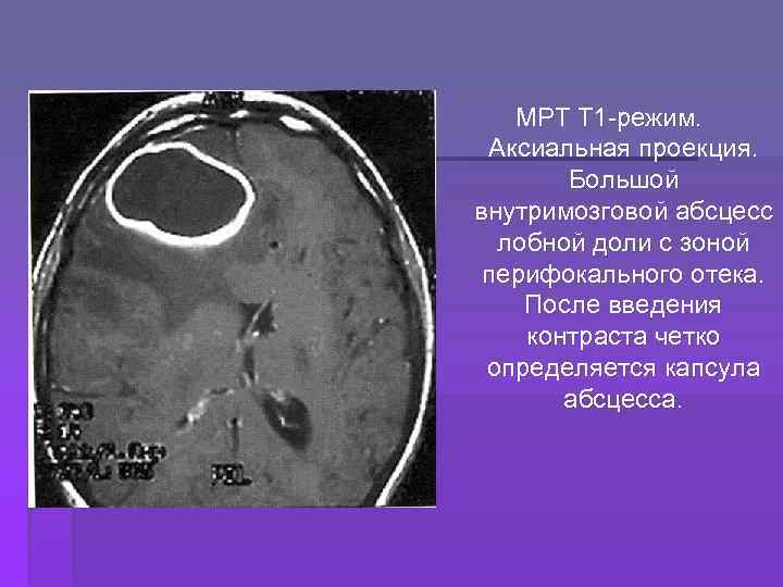 Абсцесс мозга. Внутримозговой абсцесс кт. Абсцесс риногенный мрт. Абсцесс лобной доли кт.