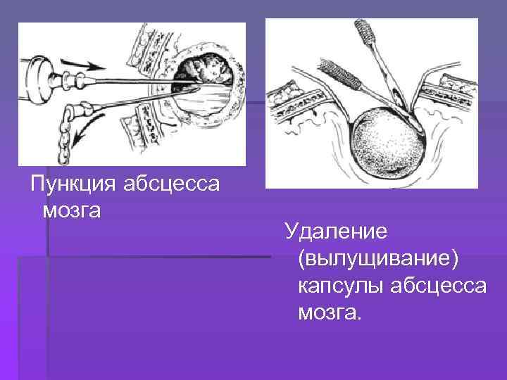  Пункция абсцесса мозга Удаление (вылущивание) капсулы абсцесса мозга. 