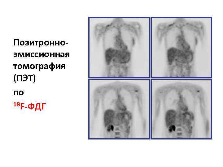 Позитронноэмиссионная томография (ПЭТ) по 18 F-ФДГ 