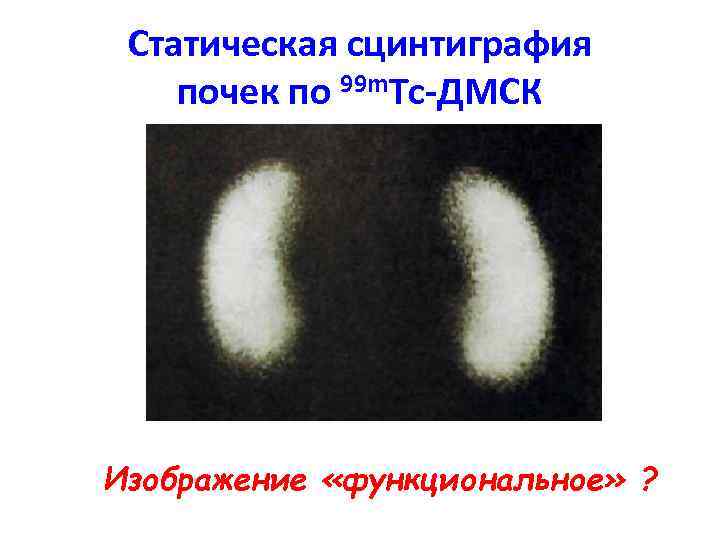Статическая сцинтиграфия почек по 99 m. Tc-ДМСК Изображение «функциональное» ? 