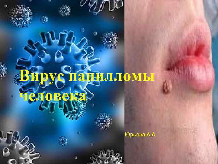 Вирус папилломы человека Юрьева А. А 